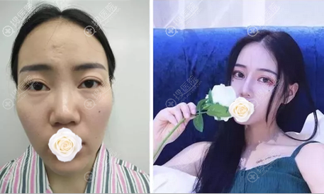 在昆明圣雅整形美容医院做的综合隆鼻让我自信到坦言整形经历