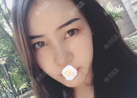 昆明圣雅综合隆鼻术后半个月 昆明圣雅综合隆鼻术后半个月