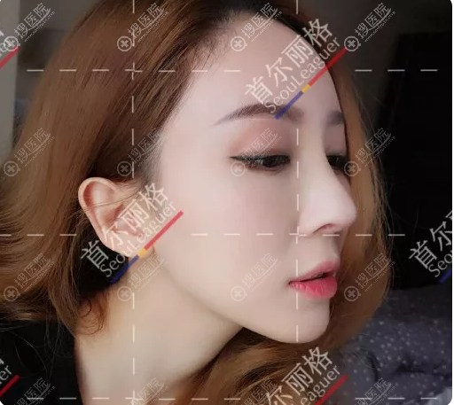 上海首尔丽格范荣杰隆鼻厉害吗?来看鼻子微晶瓷取出修复案例