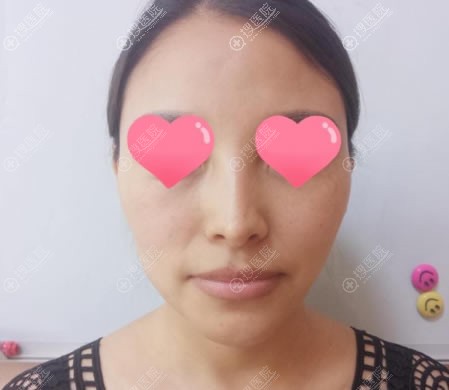 我是个公立医院控,毅然选择山西整形外科医院来做自体脂肪填充