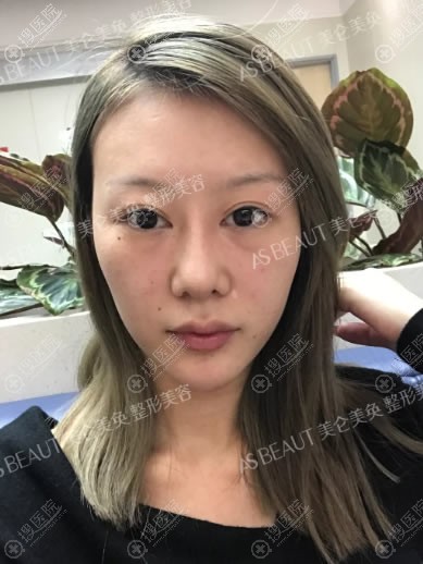 在重庆美仑美奂做脂肪填充前 在重庆美仑美奂做脂肪填充前
