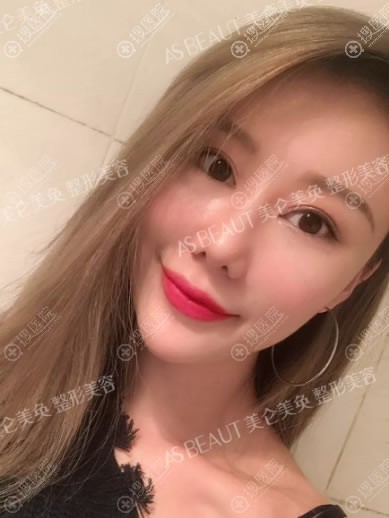 自体脂肪面部填充15天图片 自体脂肪面部填充15天图片