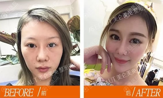 董志恿自体脂肪填充案例对比图 董志恿自体脂肪填充案例对比图