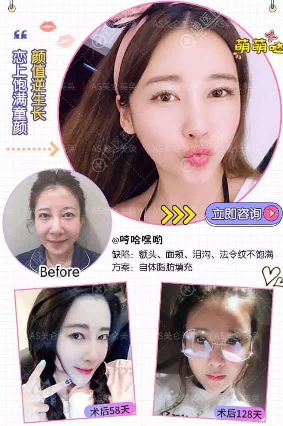 美仑美奂ACR自体脂肪填充案例 美仑美奂ACR自体脂肪填充案例