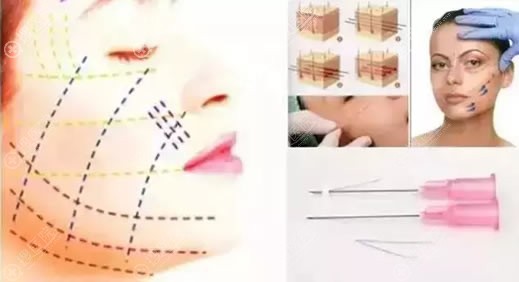 面部6D线雕和普通线雕有何区别?赣州韩美刘兴达院长用实例说话