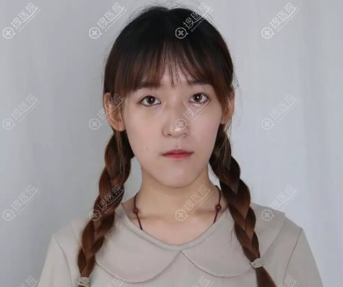 我是一名研究生,因为下巴过长选择西宁华美做了自体脂肪填充术