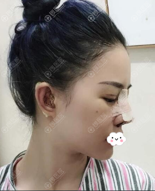 �ɶ������ü�˫��Ƥ+¡�������3��Ч��