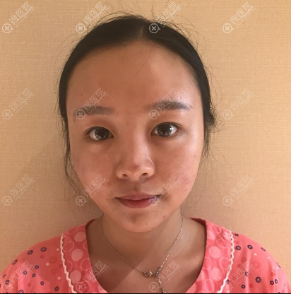 四川成都晶肤医院董薇薇做线雕多少钱?埋线提升22800元附案例