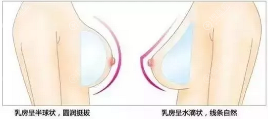 圆形假体和水滴形假体术后形状 圆形假体和水滴形假体术后形状