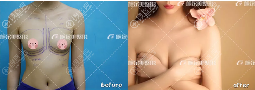 常州施尔美整形美容拥有周文隆胸案例 常州施尔美整形美容拥有周文隆胸案例