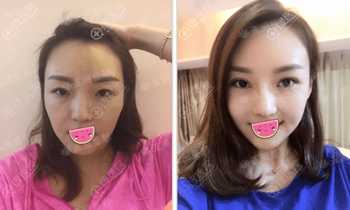 重庆五洲整形眼综合+鼻综合+面部脂肪填充 见证主妇变少女魔法