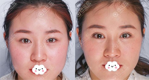 <!--<i data=20240710 data-id=13413></i>-->柏羽美杜莎双眼皮真人案例效果对比 <!--<i data=20240710 data-id=13413></i>-->柏羽美杜莎双眼皮真人案例效果对比