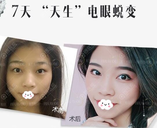 米兰柏羽美杜莎双眼皮案例效果图片 米兰柏羽美杜莎双眼皮案例效果图片