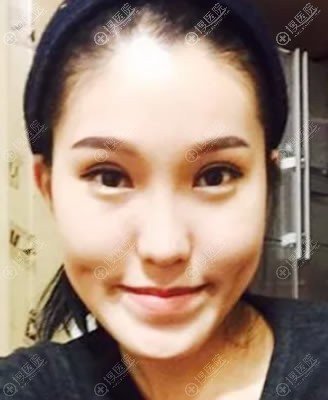 打小就下颚前突的我选择韩国原辰做下颌角手术成功矫正回去了
