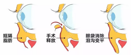 眶隔释放术手术示意图 眶隔释放术手术示意图