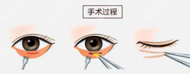 内切眼袋手术过程 内切眼袋手术过程
