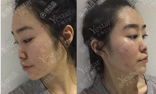 详细记录我去上海yestar找黄泽春做双眼皮和隆鼻的恢复过程