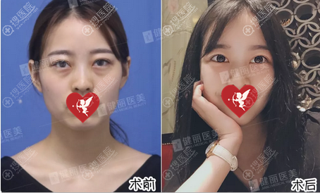 深圳健丽整形美容医院管谋去眼袋效果 深圳健丽整形美容医院管谋去眼袋效果