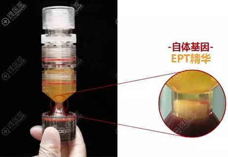 EPT脂肪技术操作示意图 EPT脂肪技术操作示意图