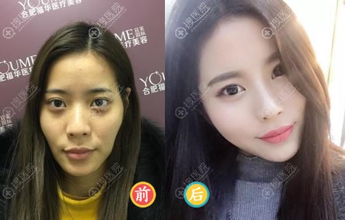 合肥福华赵章杰自体脂肪填充案例 合肥福华赵章杰自体脂肪填充案例