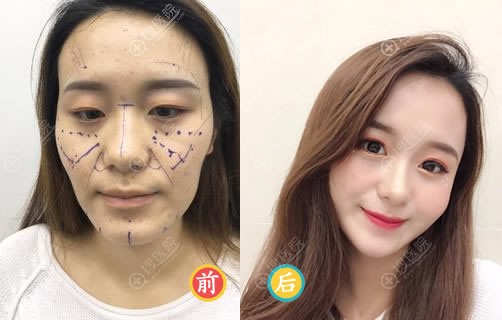 合肥福华<!--<i data=20240710 data-id=16582></i>-->自体脂肪填充案例 合肥福华<!--<i data=20240710 data-id=16582></i>-->自体脂肪填充案例