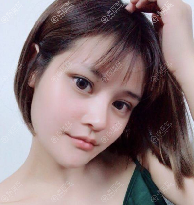 宿迁天黛整形医院隆鼻案例25天照片 宿迁天黛整形医院隆鼻案例25天照片