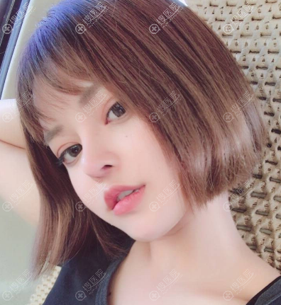在宿迁天黛做鼻子两个月恢复效果图 在宿迁天黛做鼻子两个月恢复效果图