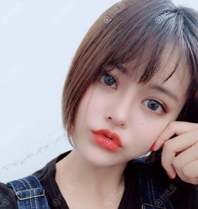 宿迁天黛整形医院沙俊丽医生做的隆鼻案例 宿迁天黛整形医院沙俊丽医生做的隆鼻案例
