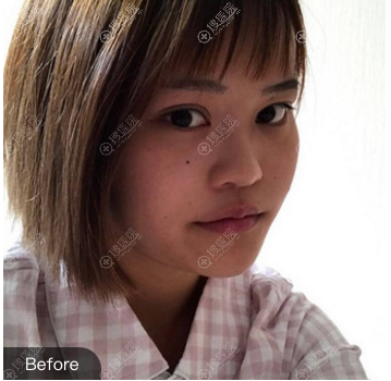 看过宿迁天黛整形医院的价格表和案例后,找沙俊丽医生做了隆鼻