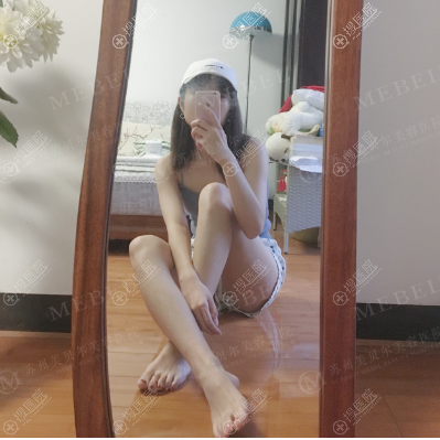 苏州美贝尔聂志宏吸脂案例术后一个月 苏州美贝尔聂志宏吸脂案例术后一个月
