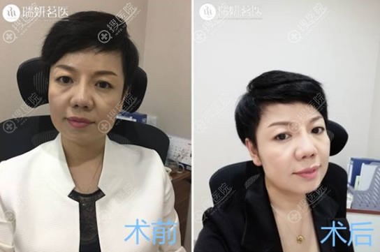 鲁树荣院长自体脂肪填充案例 鲁树荣院长自体脂肪填充案例