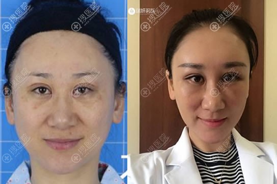 赵永刚主任自体脂肪填充案例 赵永刚主任自体脂肪填充案例