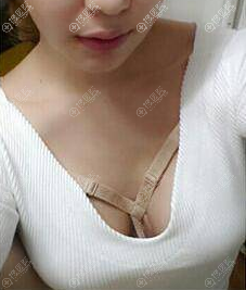 贵阳华美谢占军假体隆胸真人案例 贵阳华美谢占军假体隆胸真人案例