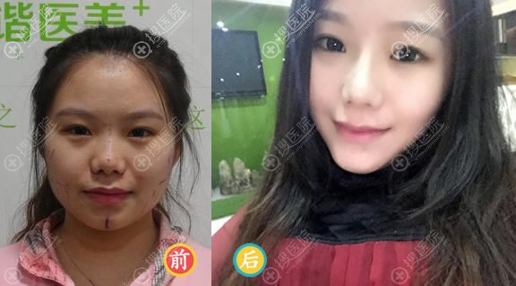 <!--<i data=20240710 data-id=12086></i>-->和谐常双明自体脂肪填充案例 <!--<i data=20240710 data-id=12086></i>-->和谐常双明自体脂肪填充案例