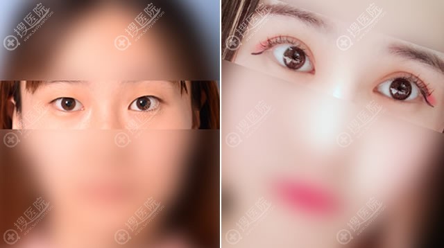 延吉金光善整形医院双眼皮案例 延吉金光善整形医院双眼皮案例