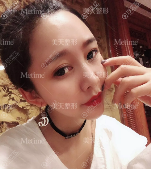 大连新华美天线雕和脂肪填充案例图片 大连新华美天线雕和脂肪填充案例图片