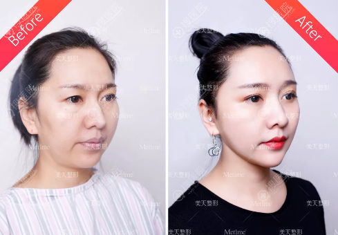 大连新华美天线雕和脂肪填充联合治疗案例对比图 大连新华美天线雕和脂肪填充联合治疗案例对比图