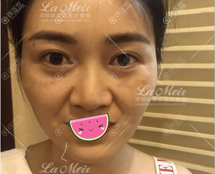 鼻综合手术术前照片 鼻综合手术术前照片