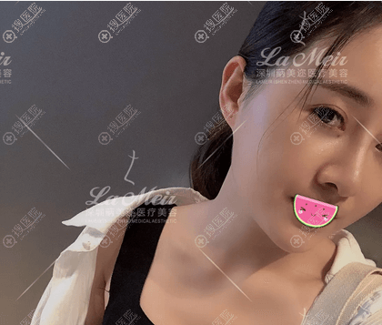 综合隆鼻拆线后效果 综合隆鼻拆线后效果