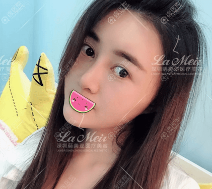 朱灿鼻综合案例术后10天恢复照片 朱灿鼻综合案例术后10天恢复照片