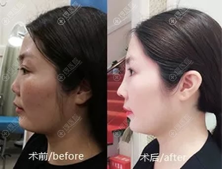 上饶韩美沈文鑫鼻综合隆鼻案例 上饶韩美沈文鑫鼻综合隆鼻案例