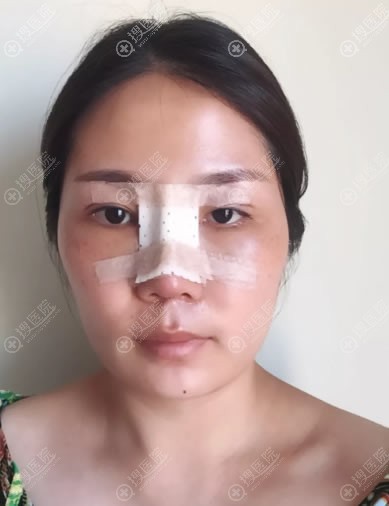 上饶韩美隆鼻手术4天恢复照 上饶韩美隆鼻手术4天恢复照