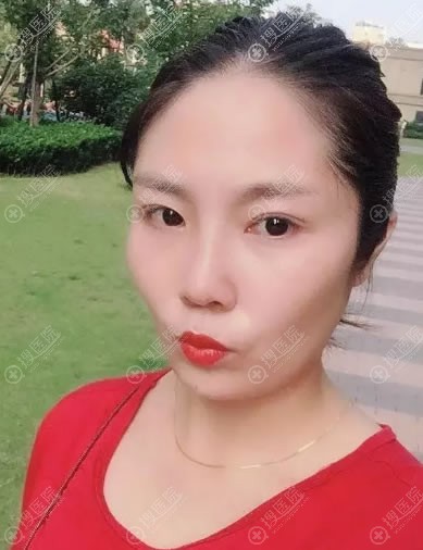 上饶韩美沈文鑫隆鼻案例10天效果 上饶韩美沈文鑫隆鼻案例10天效果