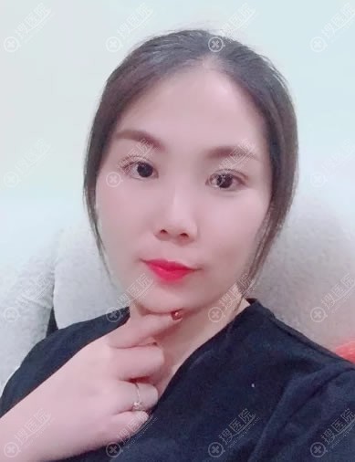做完肋软骨隆鼻20天恢复照 做完肋软骨隆鼻20天恢复照