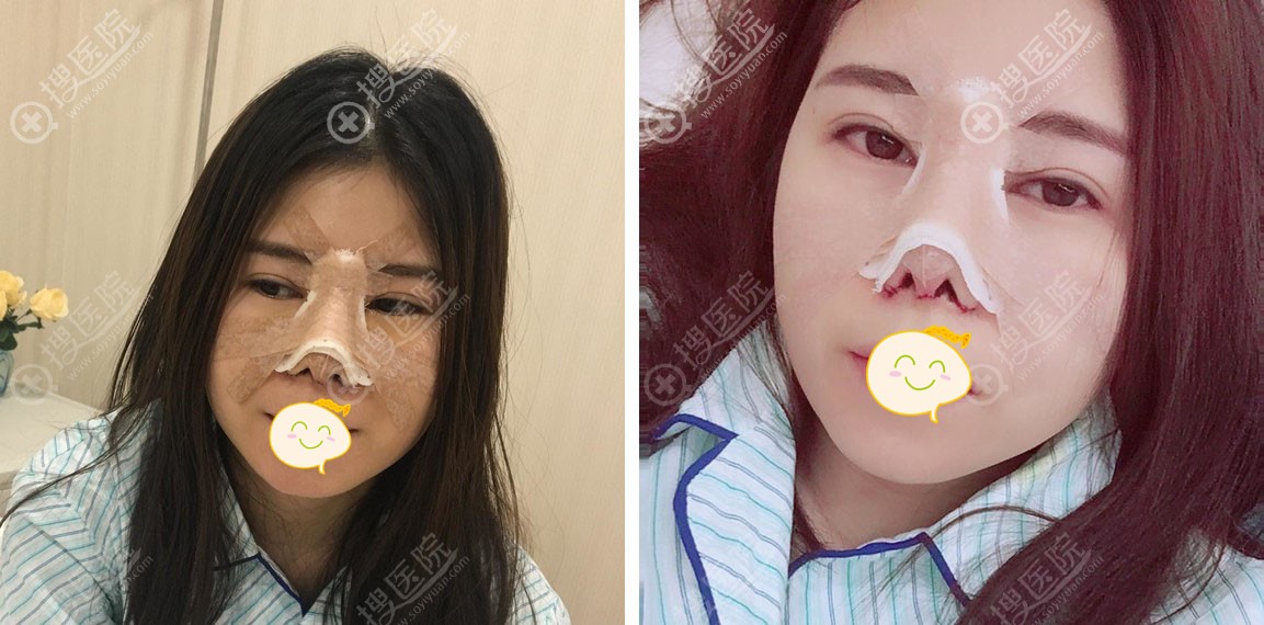 鼻综合手术天案例图 鼻综合手术天案例图