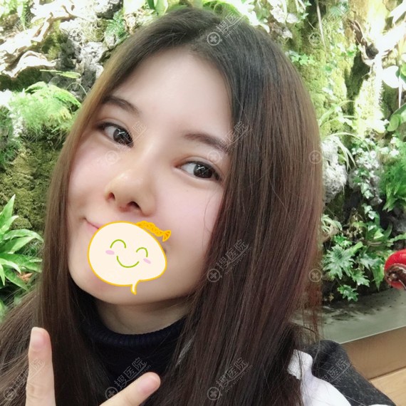 鼻综合手术拆线后效果图 鼻综合手术拆线后效果图