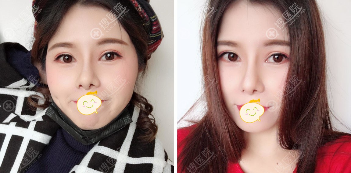 鼻综合手术一个月案例图 鼻综合手术一个月案例图