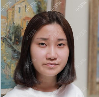 听说西安小寨伊美尔是正规整形医院,面诊完找王飞做了双眼皮
