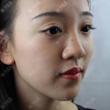 看了上海yestar李建兵的隆鼻案例后直接预约了肋软骨隆鼻手术