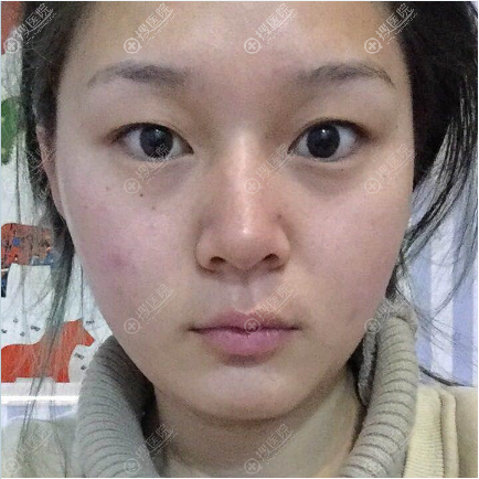 术前单眼皮照片 术前单眼皮照片